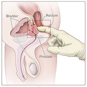 cancer de prostata quando operar papilloma virus sintomi gola